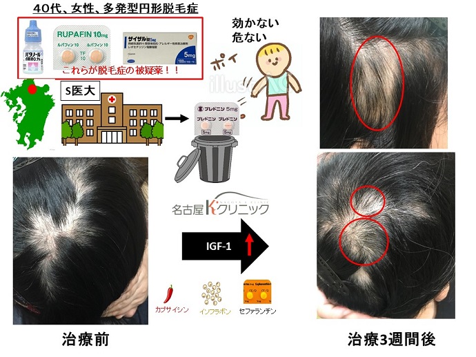 円形脱毛症　病院